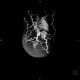 Caput medusae, liver cirrhosis, alcoholic liver cirrhosis, portal hypertension, splenomegally: CT - Computed tomography